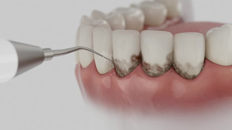 Trusted Invisalign Clear Aligners service in Barry, IL - Dentist Open Now